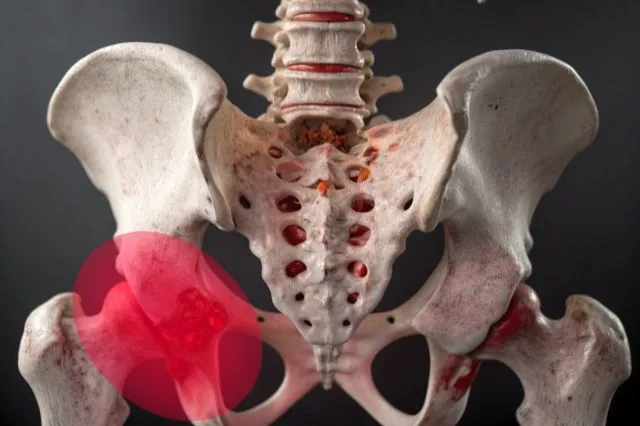 坐骨神経痛の原因となる骨盤と神経の模型写真