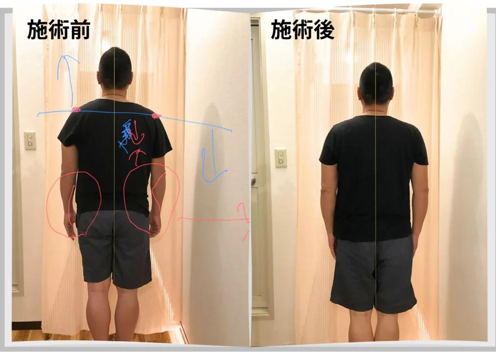 六本木の整体 モビリティ整体ソシオ六本木店で施術前後の姿勢バランスを比較している様子