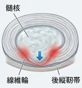 椎間板の構造｜繊維輪と髄核の関係を示した図