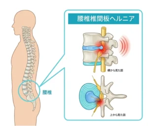 腰椎椎間板ヘルニアの仕組み｜椎間板の髄核が飛び出して神経を圧迫する状態