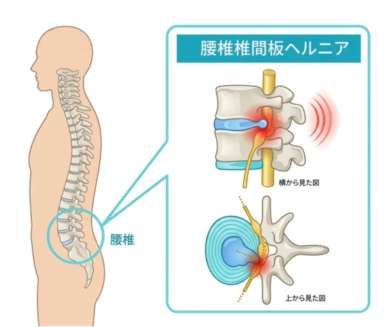椎間板の髄核が外へ飛び出して神経に触れる腰椎椎間板ヘルニアの仕組み