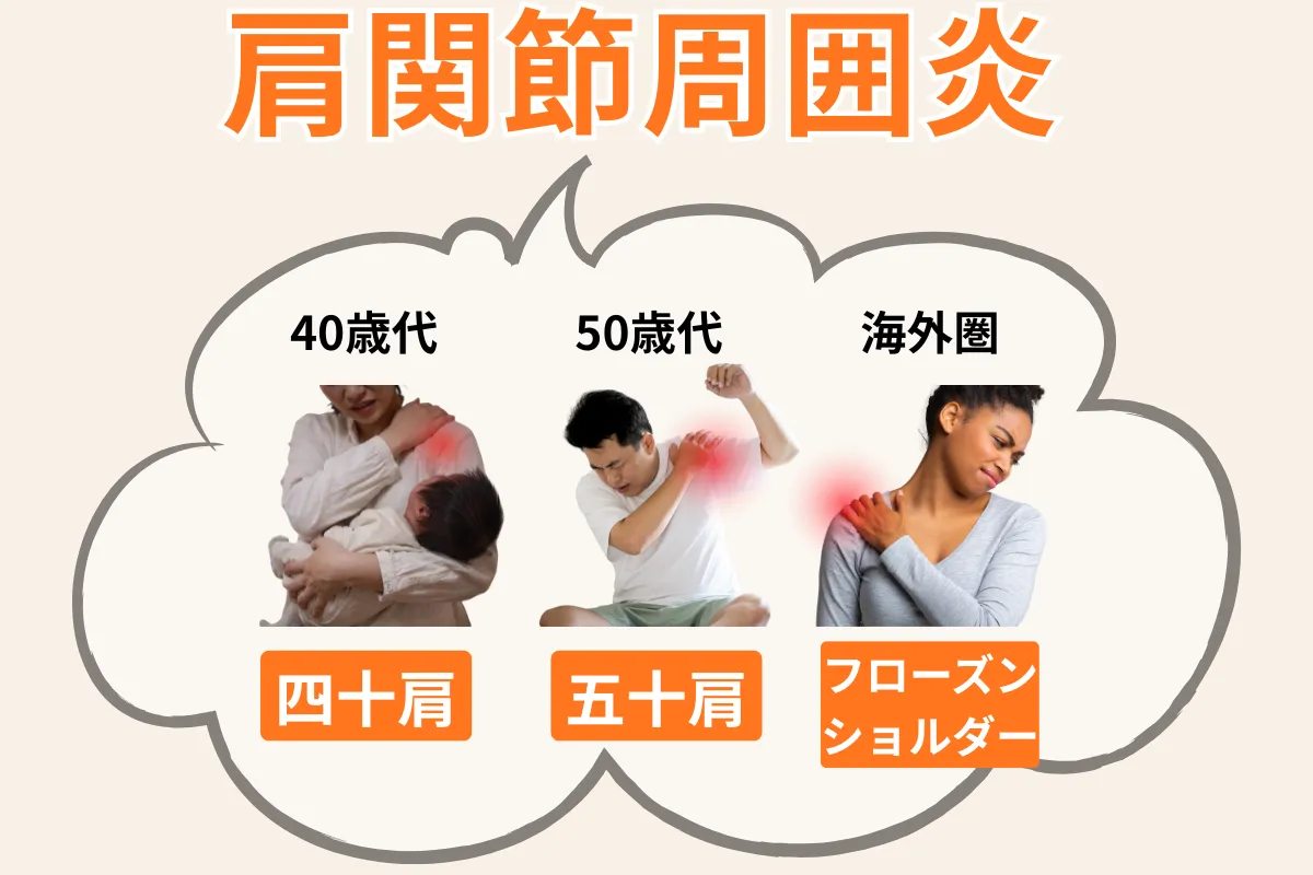 五十肩・四十肩・肩関節周囲炎・Frozen Shoulderの関係を示した図解